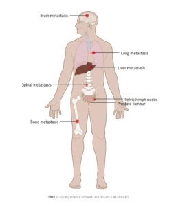 Metastatic disease