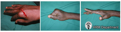 Extensor tendon injury, pre and post operation