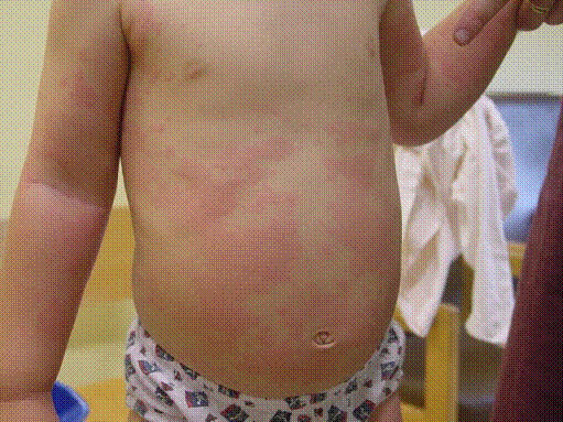 Urticaria