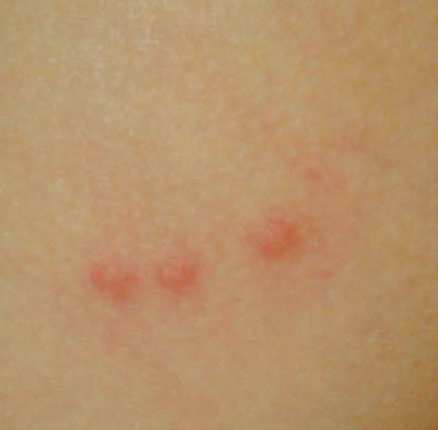 Urticaria
