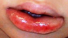 Angioedema - Lip