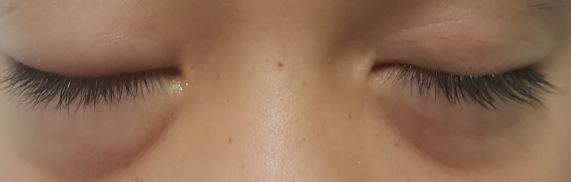Angioedema - Eye