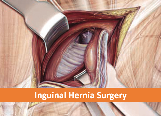 Inguinal Hernia Surgery label.png