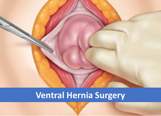 Ventral Hernia Surgery label.png