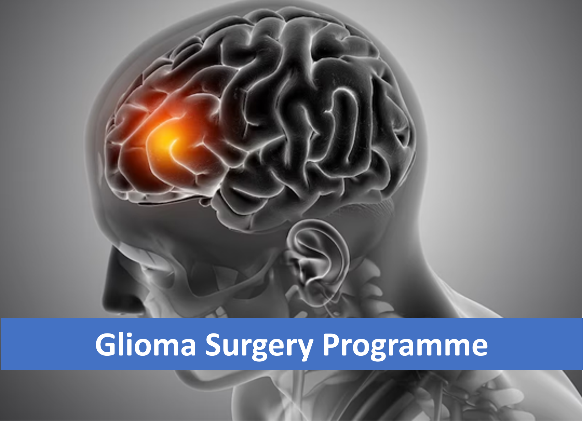 Glioma Surgery Programme
