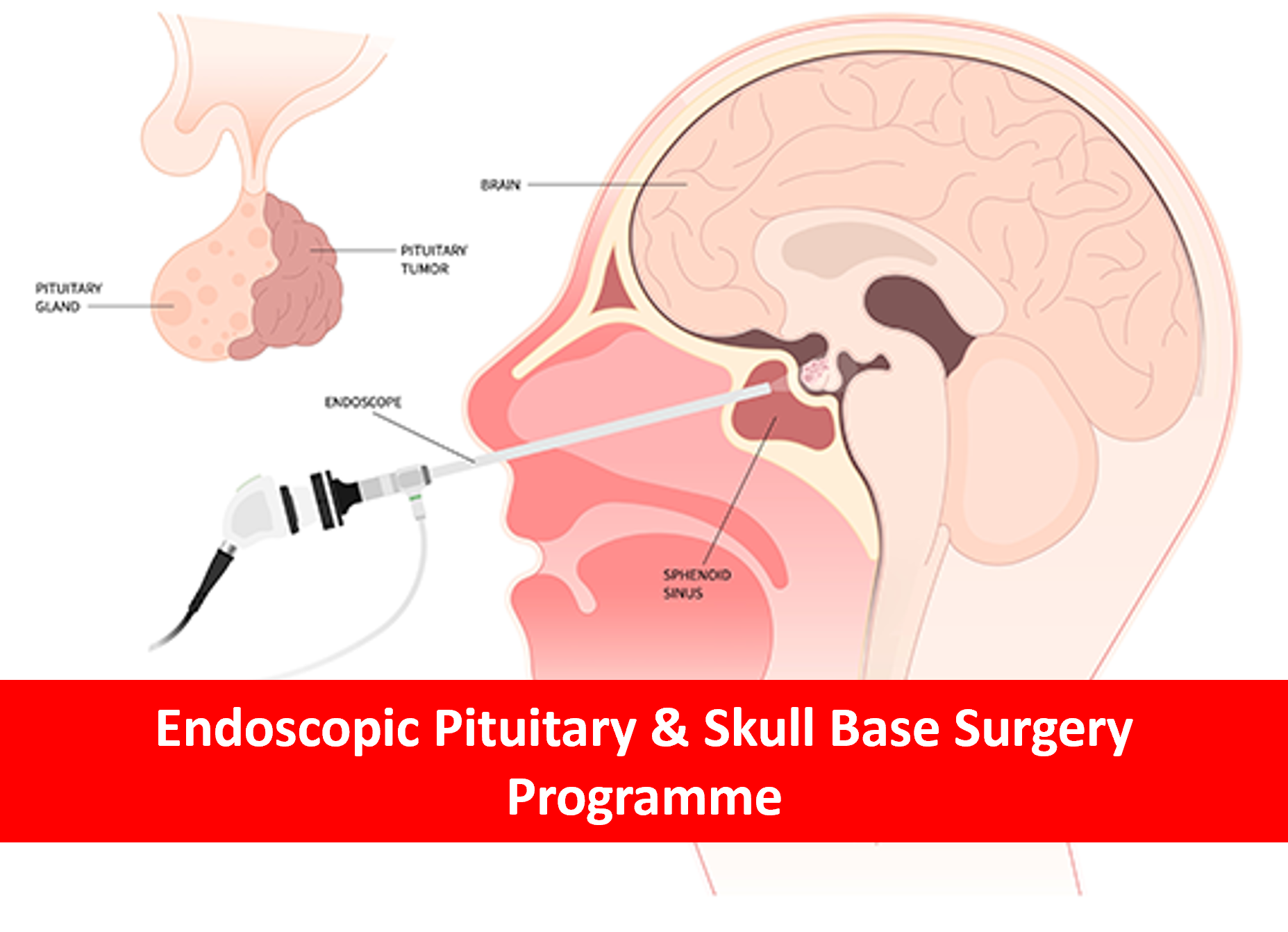 Endoscopy Pituitary