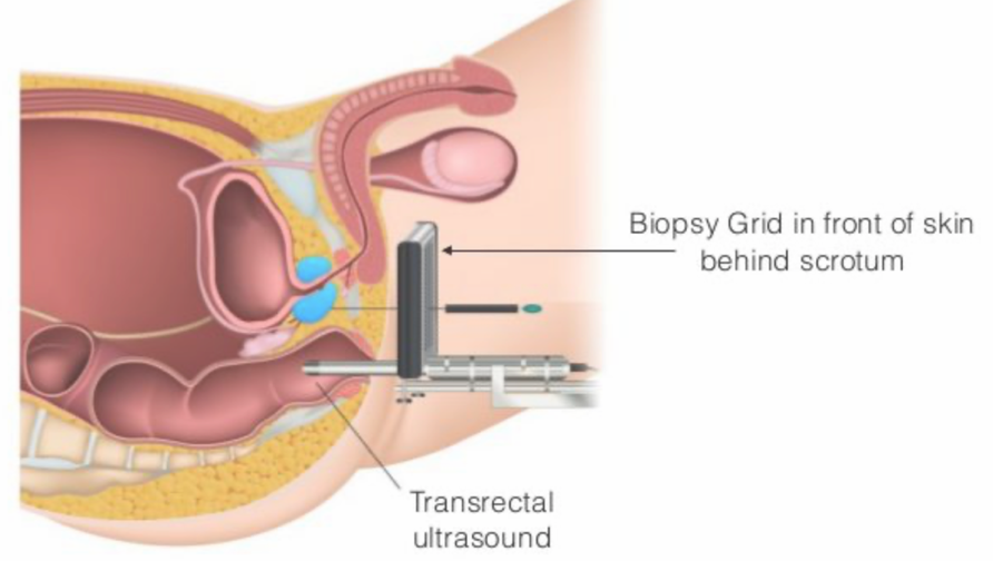 transperineal biopsy.png