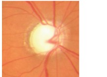 Optic disc in a patient with glaucoma.jpg
