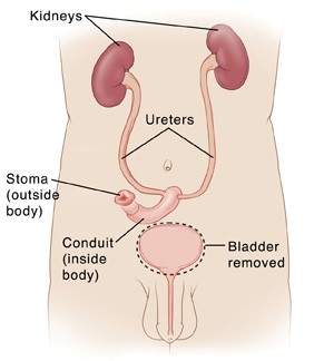 cystectomy.jpg